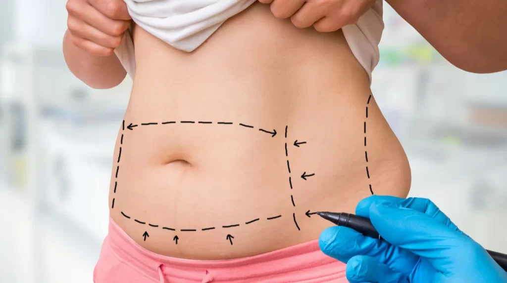 Doç. Dr. Can İlker DEMİR - Liposuction